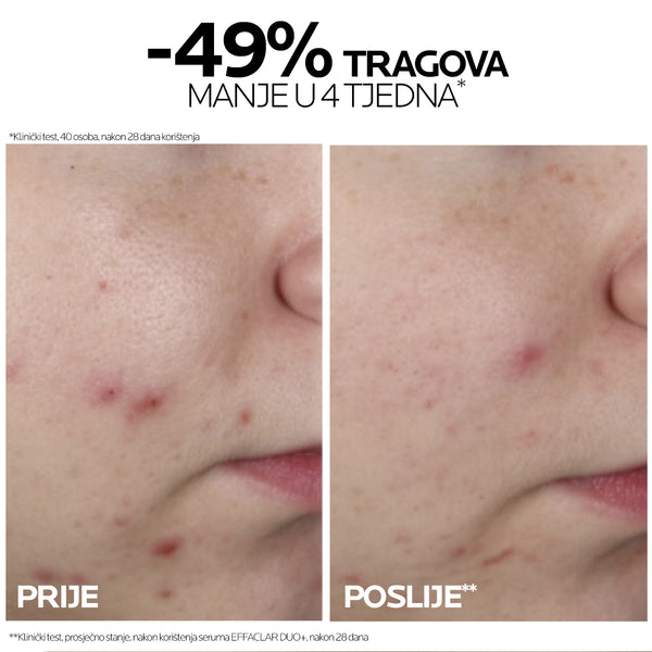 La Roche-Posay Effaclar Ultra koncentrirani serum 30 ml